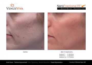 VenusViva_B&A_RhondaHayre_Face_6Tx_1